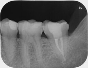 Zahnarzt Oberursel Dr Mareike Buzello Endodontie Röntgenbild1
